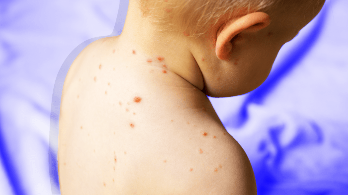 Do you need a measles vaccine booster