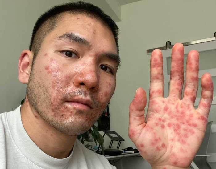 Mpox is still health emergency who says